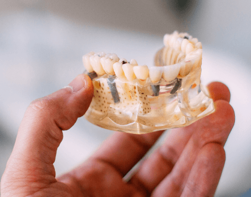 dental implants